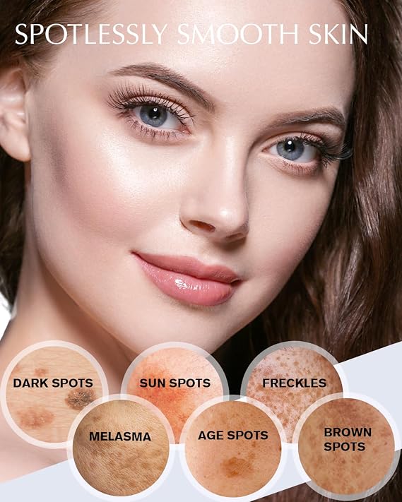 Hyperpigmentation Treatment - Natural Ingredient - Freckle/Melasma/Sun Spot/Age Spot Remover Dark Spot Corrector Cream